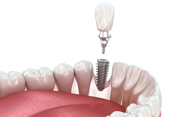 How To Care For Your New Dental Implant Restoration