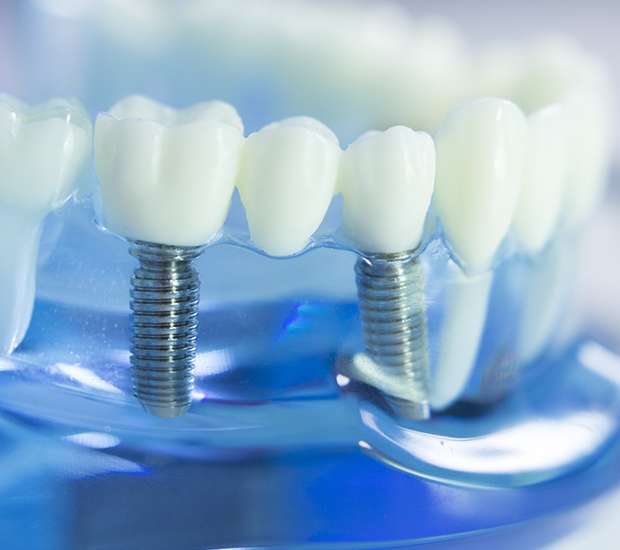 Nashua Dental Implants