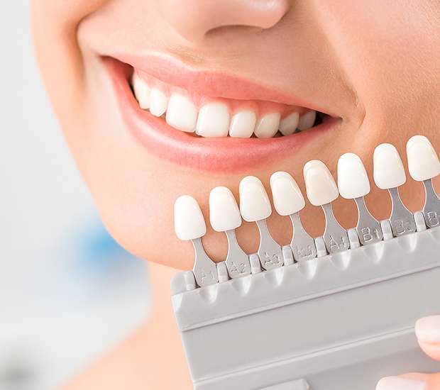 Nashua Dental Veneers and Dental Laminates
